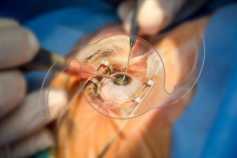 Complex Cataract Surgery