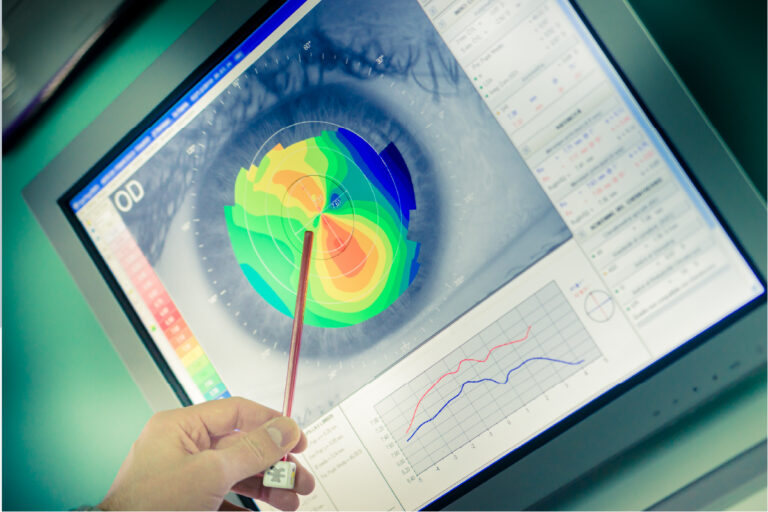 Corneal Topography